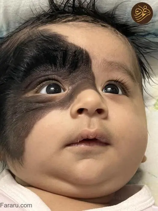 تصاویر تولد یک نوزاد عجیب با خال غول‌ پیکر مودار روی صورت