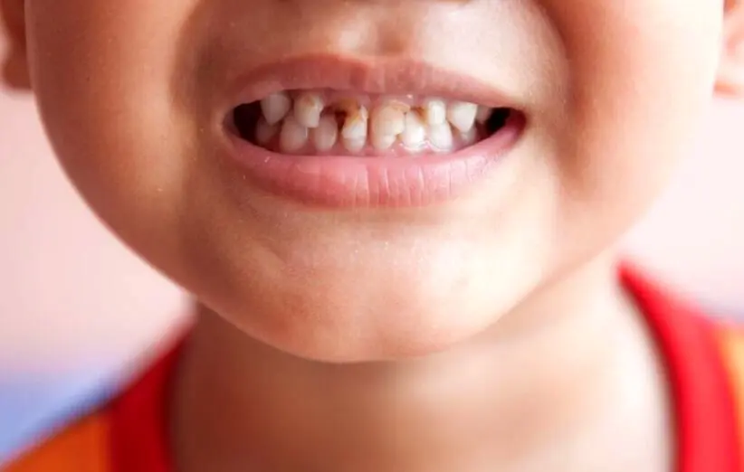 مراقبت از دندان‌ های کودکان