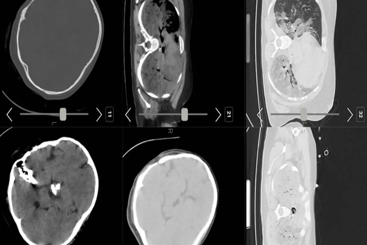 جزئیات عمل تومور مغزی «مهسا امینی» به روایت رئیس دانشگاه علوم پزشکی تهران