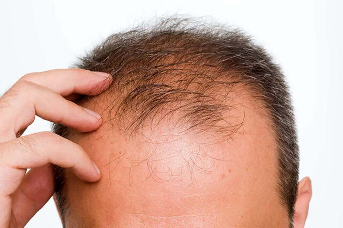 نوشابه انرژی زا عامل تشدیدکننده ریزش مو درمردان