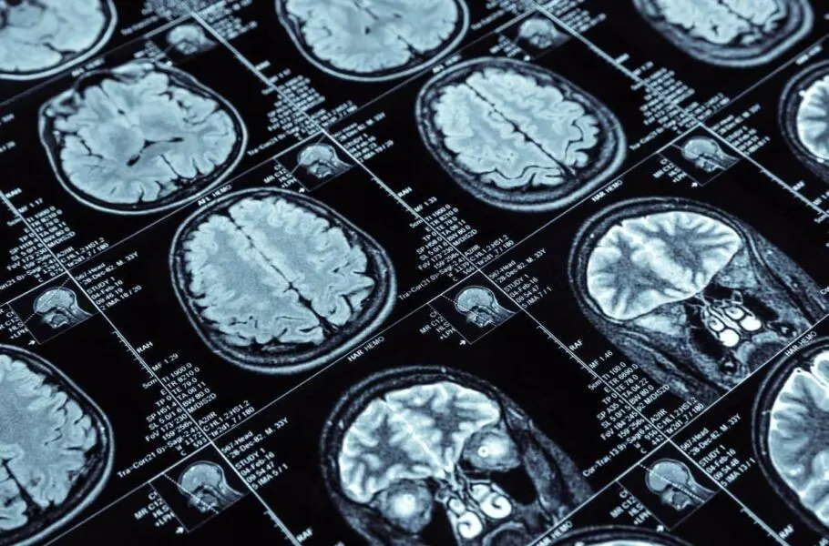 محققان روشی جدید برای ارسال دارو به درون مغز و درمان آلزایمر پیدا کردند