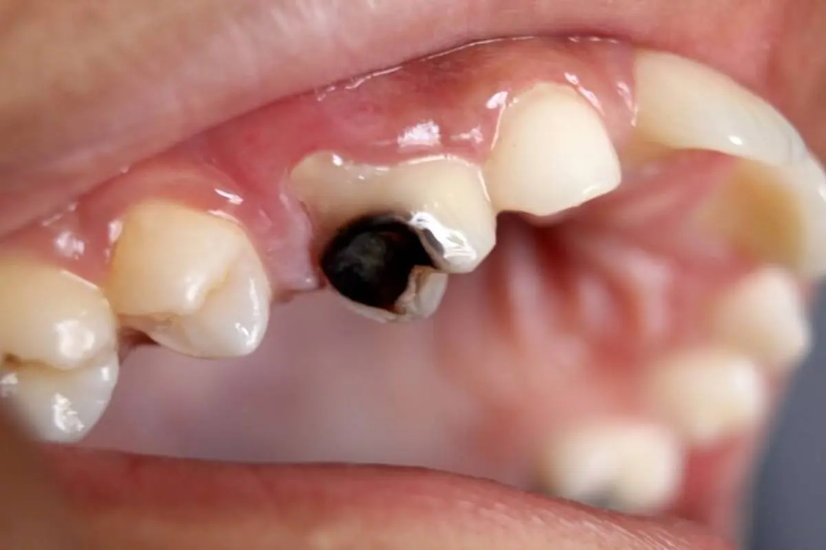 راه‌ های درمان پوسیدگی دندان
