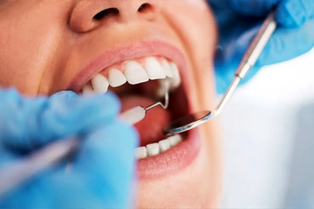 آیا جرم‌گیری به دندان‌ها آسیب می‌رساند؟