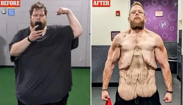 تصاویر شوکه کننده از مردی که ۱۵۲ کیلو وزن کم کرد!