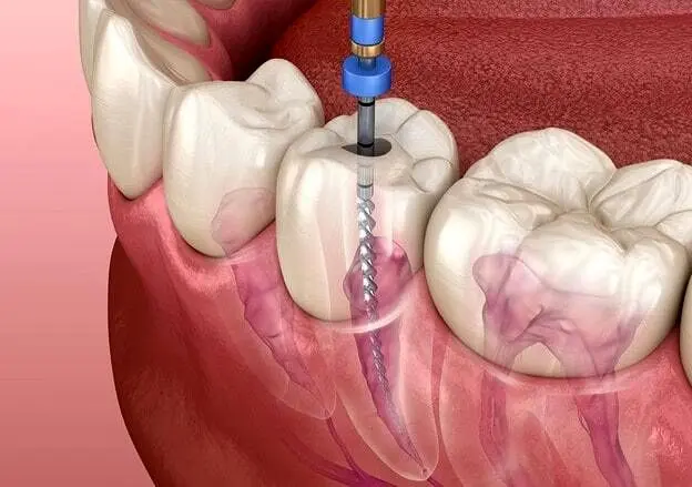انیمیشنی از نحوه عصب کشی دندان