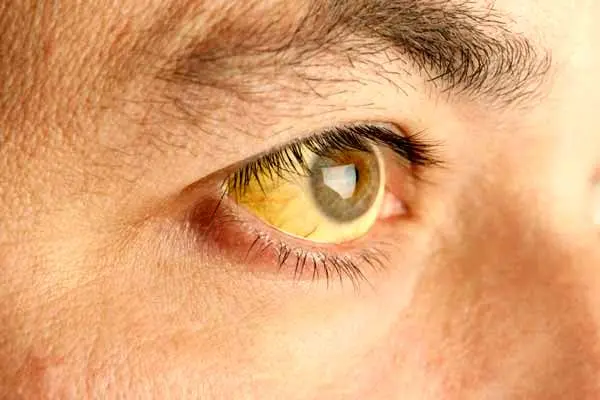 علت لکه زرد در چشم