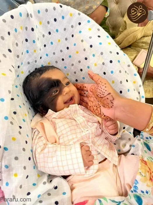 تصاویر تولد یک نوزاد عجیب با خال غول‌ پیکر مودار روی صورت